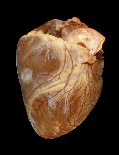 Cancer Heart